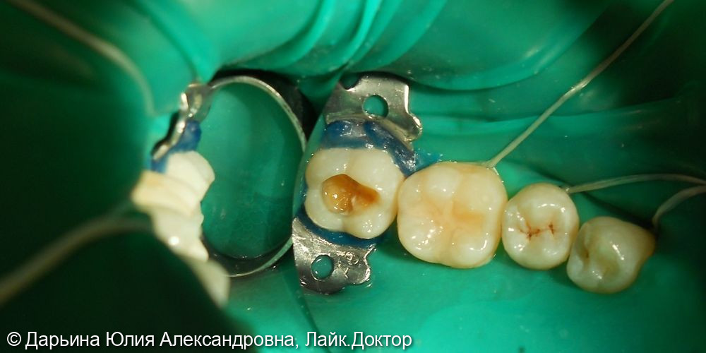 Композитная реставрация 45, 47 зубов - фото №1