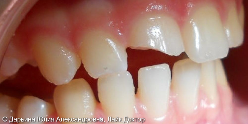 Лечение травмы зуба - фото №1