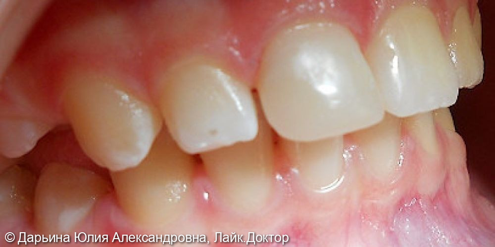 Лечение травмы зуба - фото №2