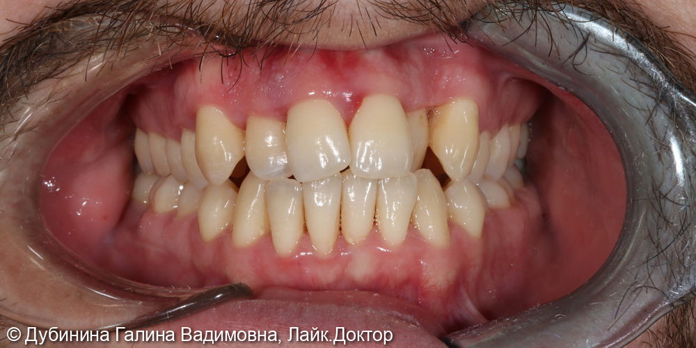 Ортодонтическое исправление прикуса. Брекет-система Damon Q - фото №1