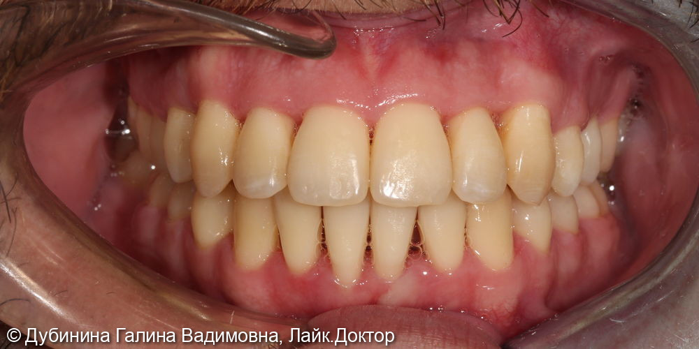 Ортодонтическое исправление прикуса. Брекет-система Damon Q - фото №2