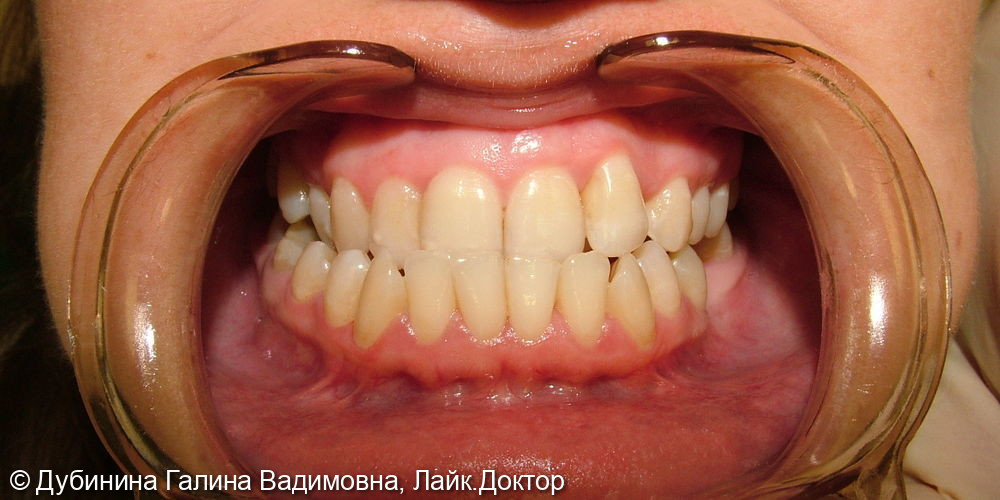 Идеально ровные зубы - фото №1