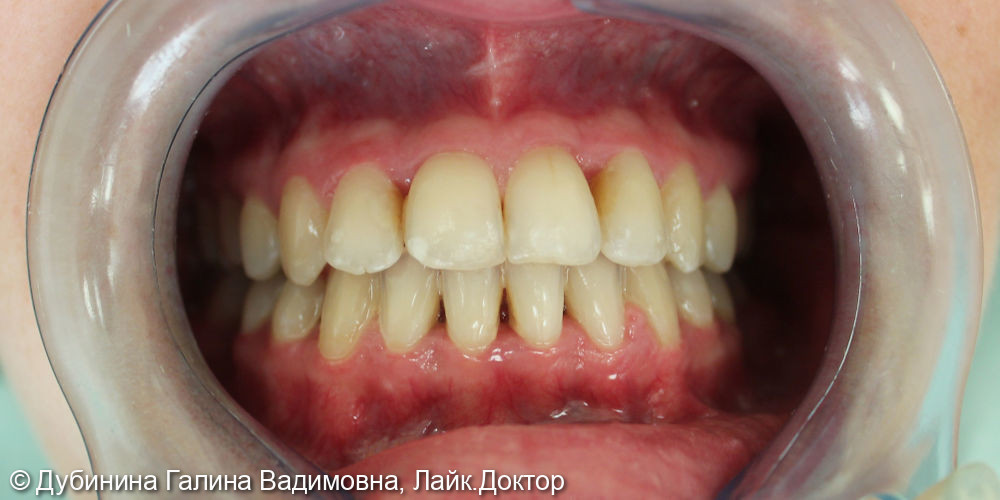 Идеально ровные зубы - фото №2