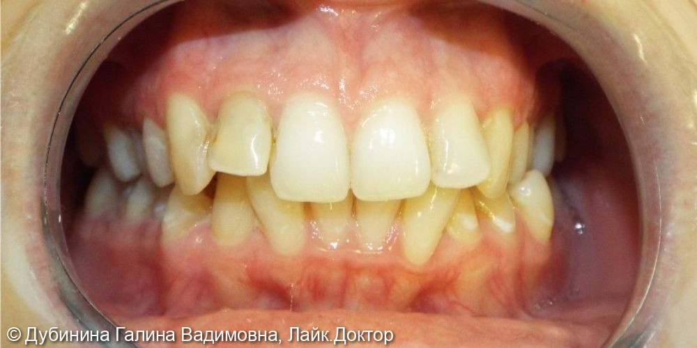 Ортодонтическое исправление прикуса и виниры - фото №1