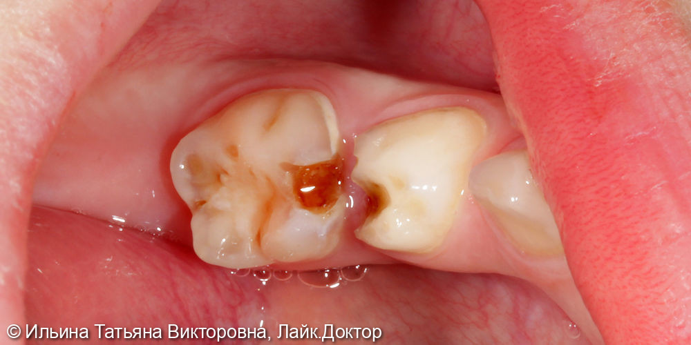Лечение постоянного жевательного зуба - фото №1