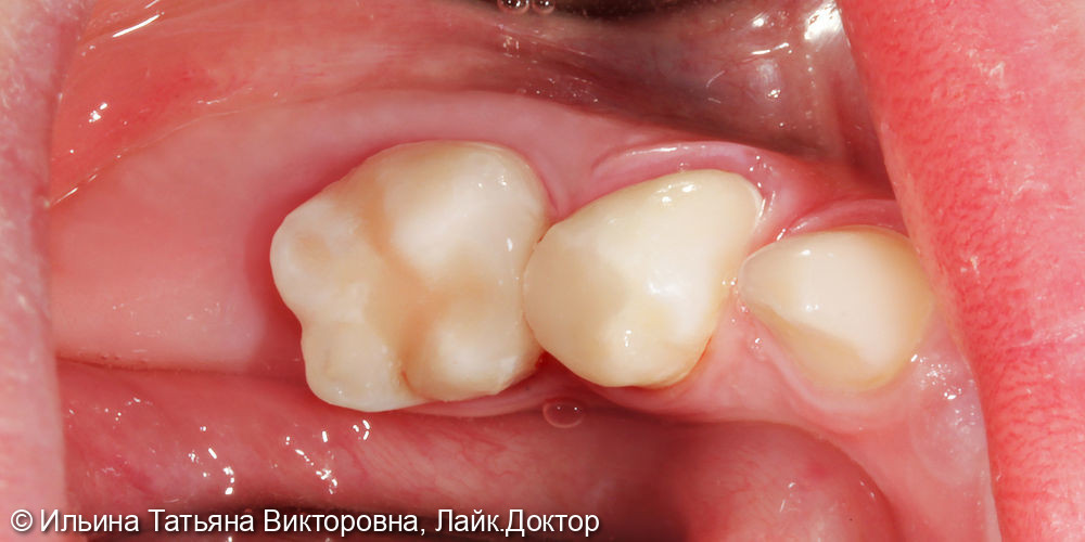 Лечение постоянного жевательного зуба - фото №2