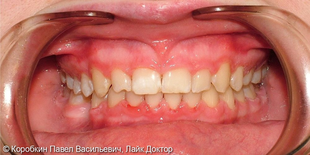 Тотальное протезирование в условиях высокой стираемости зубов - фото №1