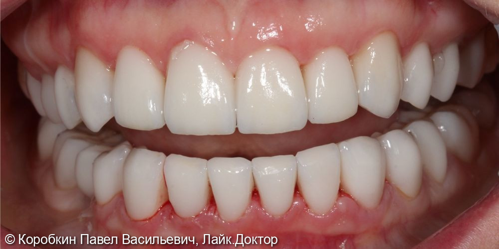 Тотальное протезирование в условиях высокой стираемости зубов - фото №2