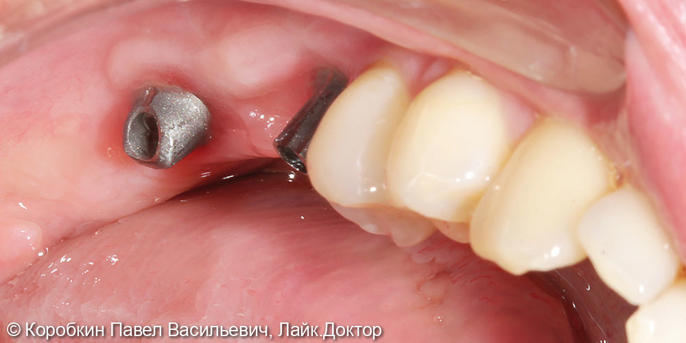 Протезирование жевательных зубов на имплататах - фото №1