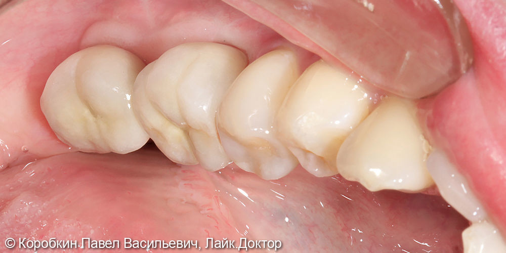 Протезирование жевательных зубов на имплататах - фото №2