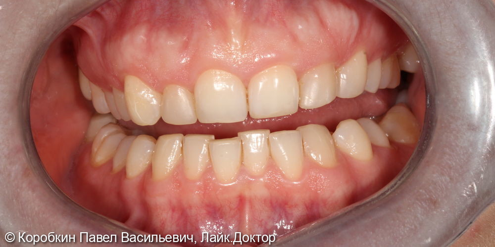 Тотальная эстетическое протезирование керамикой е.Max - фото №1