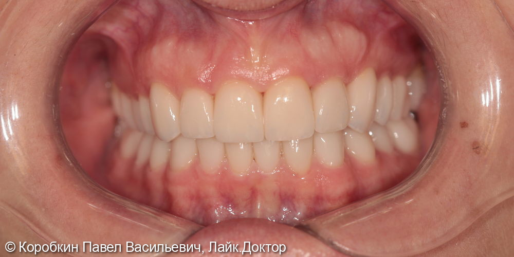 Тотальная эстетическое протезирование керамикой е.Max - фото №2