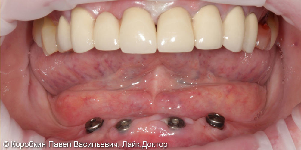 Протезирование на имплантатах "Все на 4-х" - фото №1