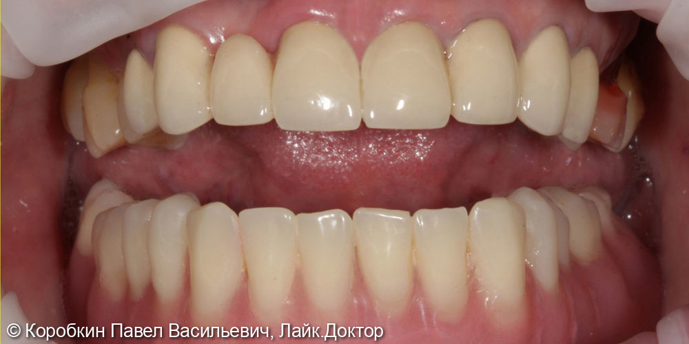 Протезирование на имплантатах "Все на 4-х" - фото №2