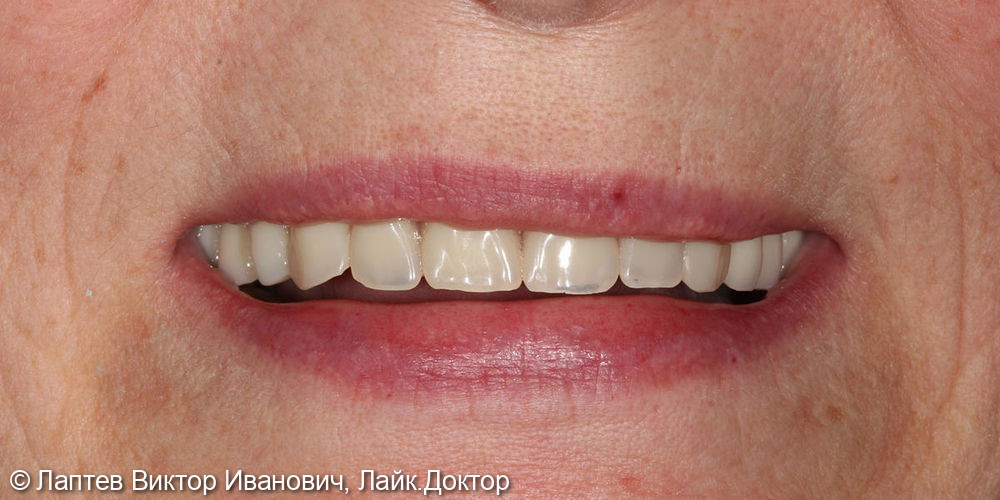 Новые зубы для жительницы Крайнего Севера - фото №7