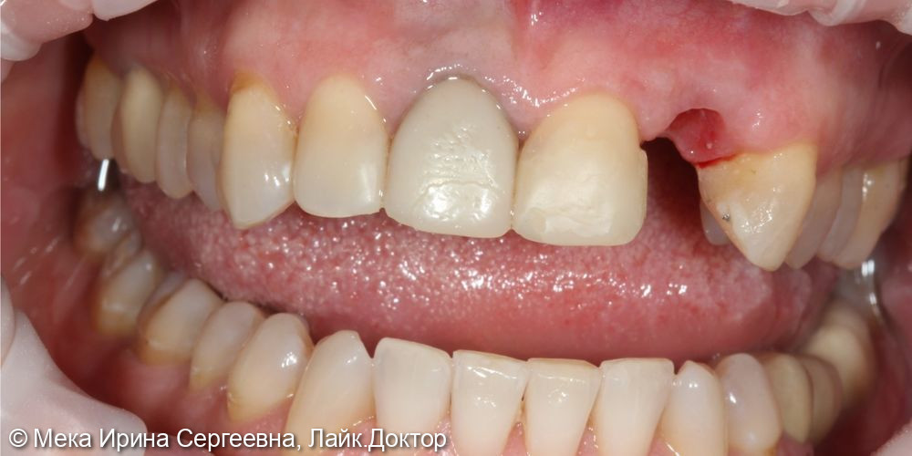 Имплантация фронтального зуба с пластикой десны - фото №1