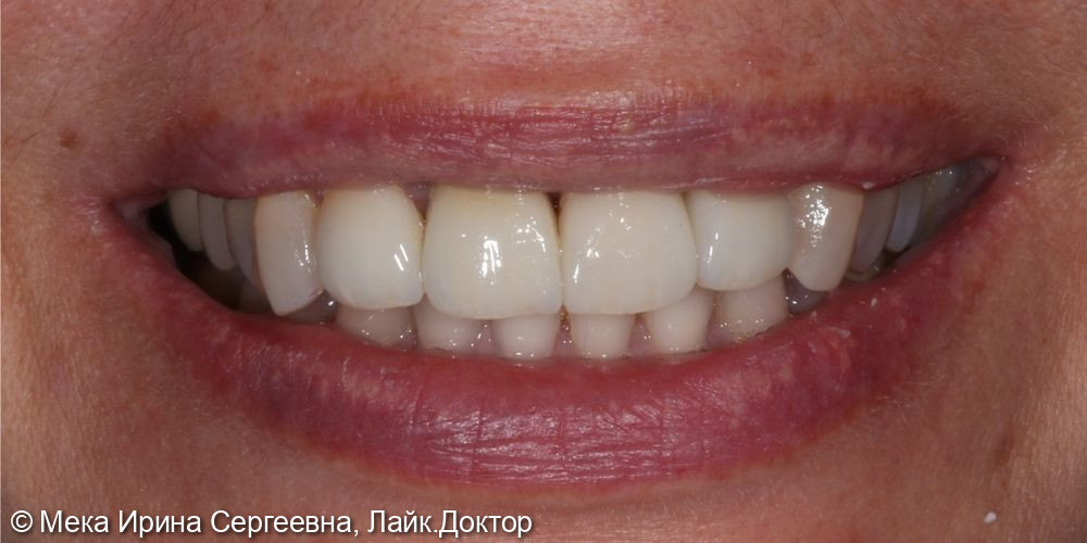 Имплантация фронтального зуба с пластикой десны - фото №2