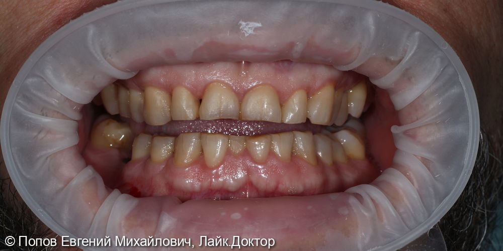 Протезирование на имплантатах Straumann и собственных зубах - фото №1