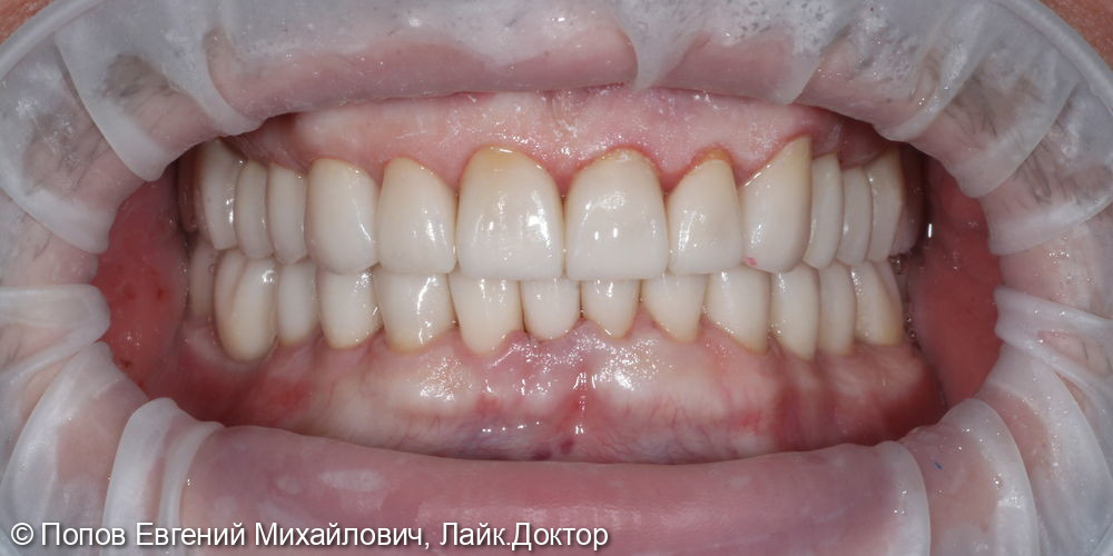 Протезирование на имплантатах Straumann и собственных зубах - фото №2