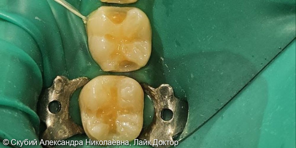 Лечение кариеса зубов у детей - фото №1