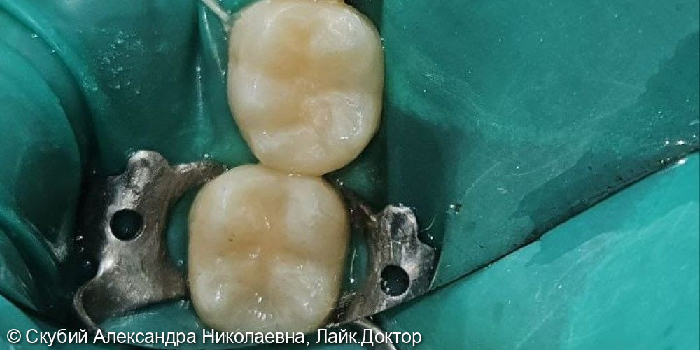 Лечение кариеса зубов у детей - фото №2