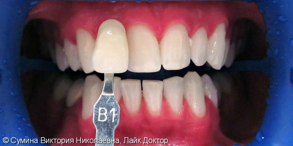 Офисное отбеливание зубов ZOOM Advanced Power - фото №2