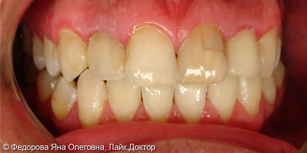 Эстетическая реставрация переднего зуба, замена старой пломбы - фото №1
