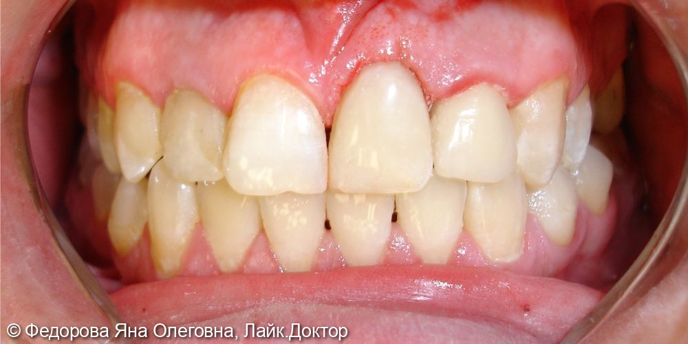 Эстетическая реставрация переднего зуба, замена старой пломбы - фото №2