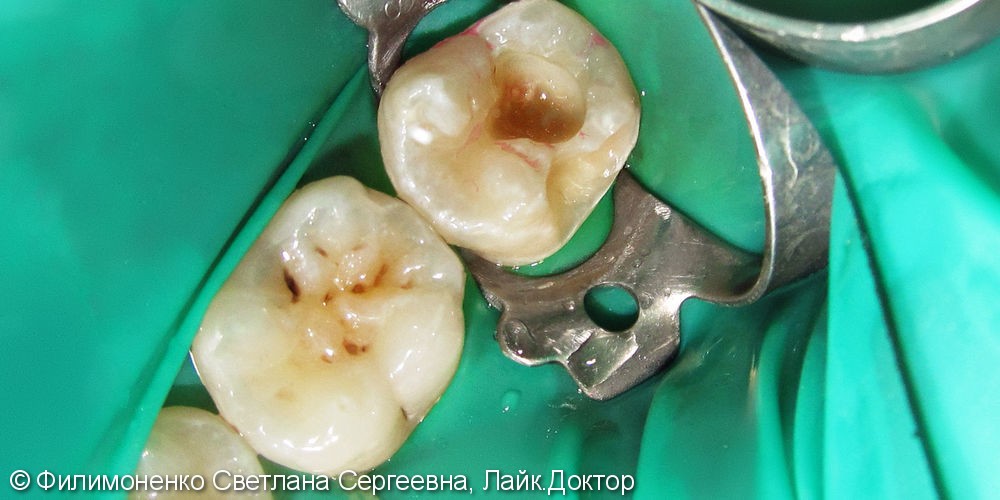 Восстановление точной анатомической формы зубов методом силиконового ключа - фото №1