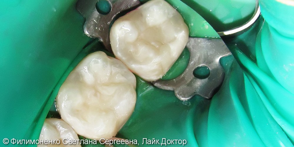 Восстановление точной анатомической формы зубов методом силиконового ключа - фото №2