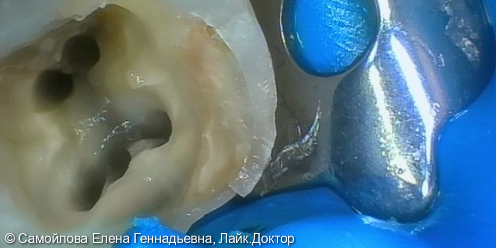 Лечение острого пульпита 4.6 зуба - фото №2