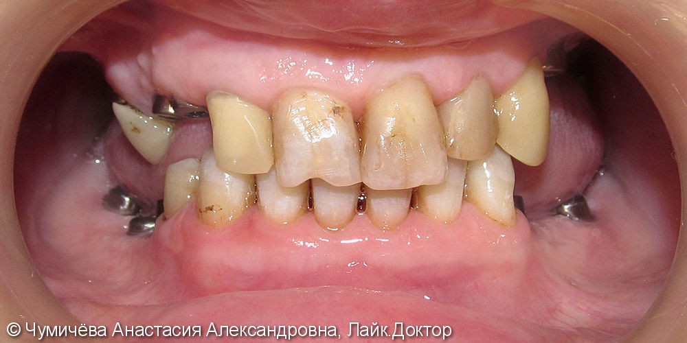 Тотальное протезирование с целью улучшения эстетики и функции зубного ряда - фото №1