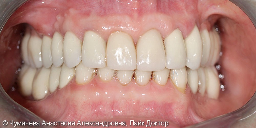 Тотальное протезирование с целью улучшения эстетики и функции зубного ряда - фото №2