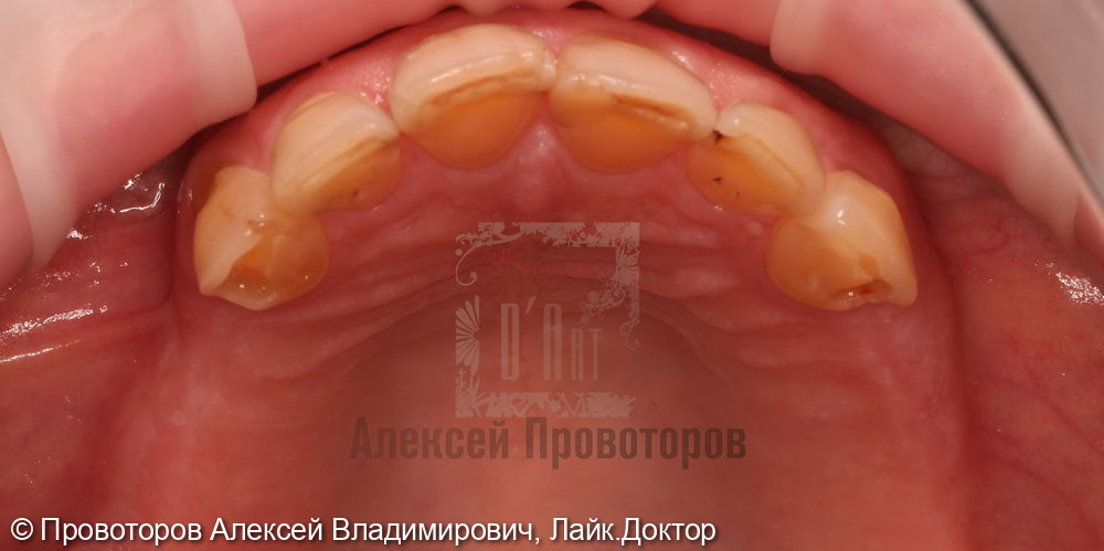 Тотальная реабилитация полости рта - фото №2
