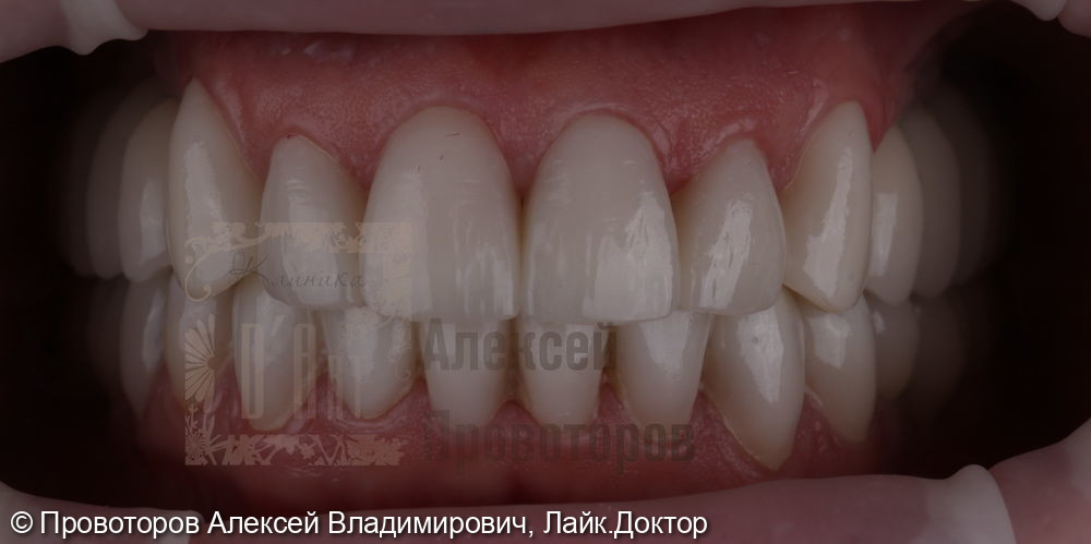 Тотальная реабилитация полости рта - фото №10