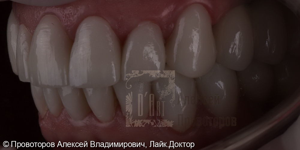 Тотальная реабилитация полости рта - фото №7