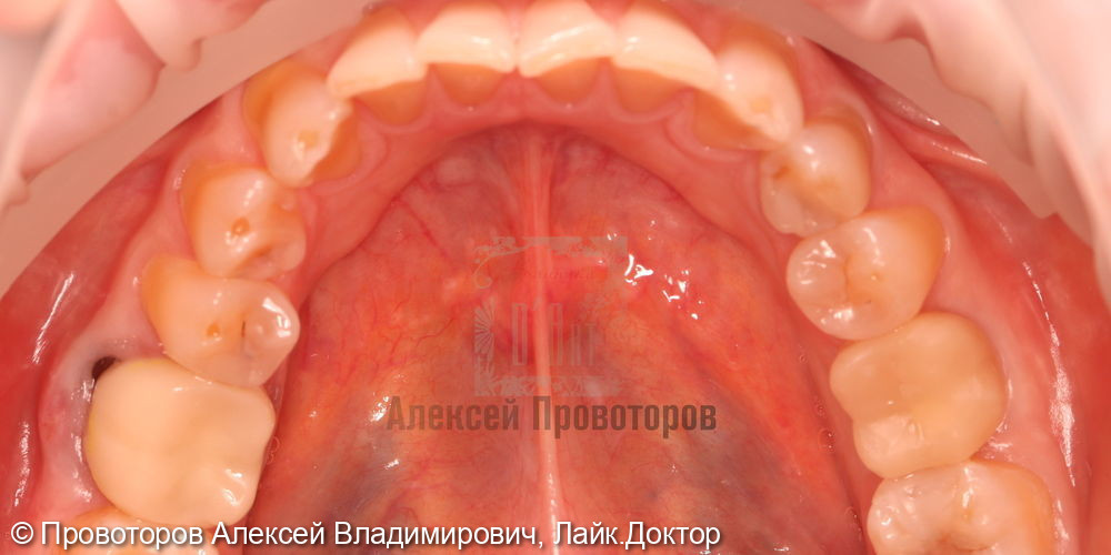 Сложное ортодонтическое лечение - фото №9