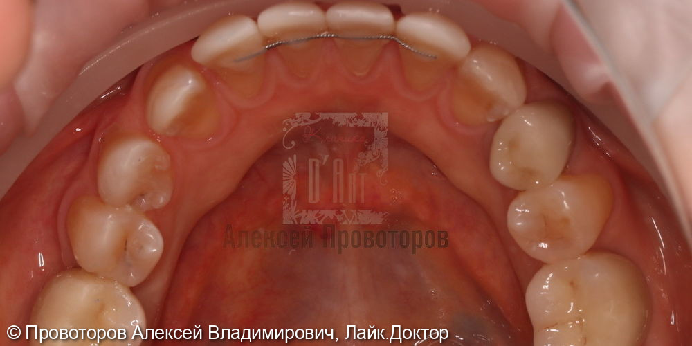 Сложное ортодонтическое лечение - фото №10