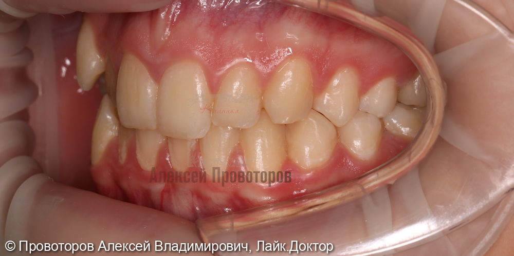 Ортодонтическое лечение - фото №4
