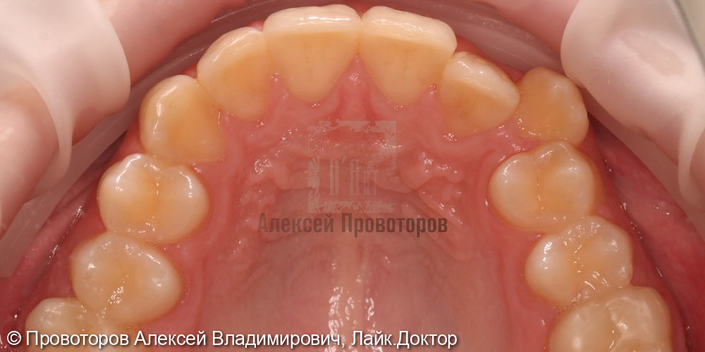 Ортодонтическое лечение - фото №6
