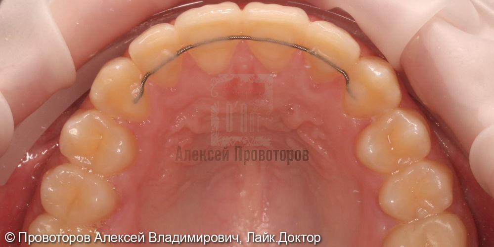 Ортодонтическое лечение - фото №7