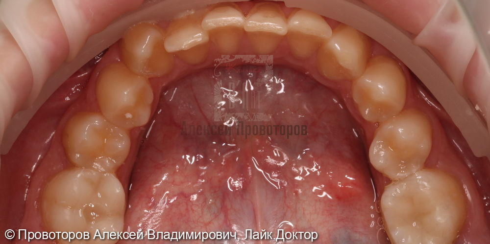 Ортодонтическое лечение - фото №8