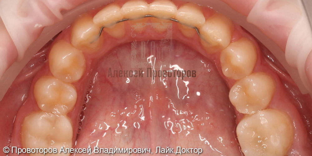 Ортодонтическое лечение - фото №9