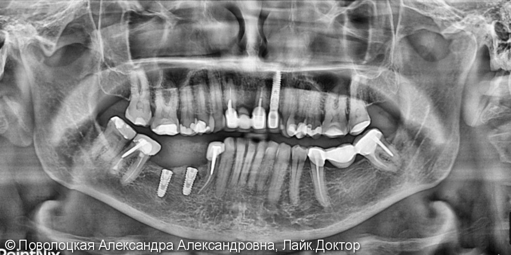 Костная пластика по Ф.Кури, дентальная имплантация 45 46 зубов - фото №2