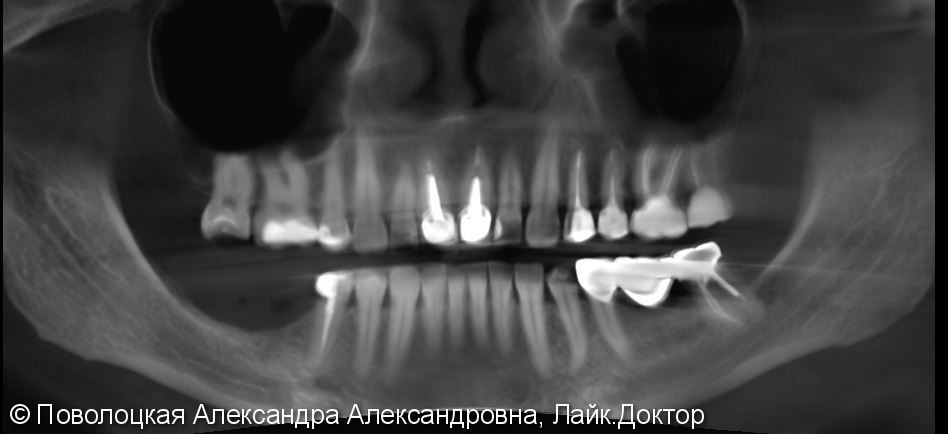 3D костная пластика и дентальная имплантация 46 47 зубов - фото №4