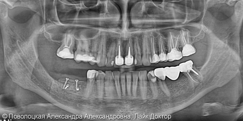 3D костная пластика и дентальная имплантация 46 47 зубов - фото №5