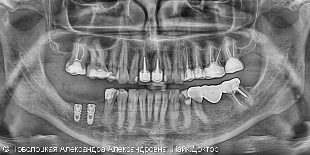 3D костная пластика и дентальная имплантация 46 47 зубов - фото №6
