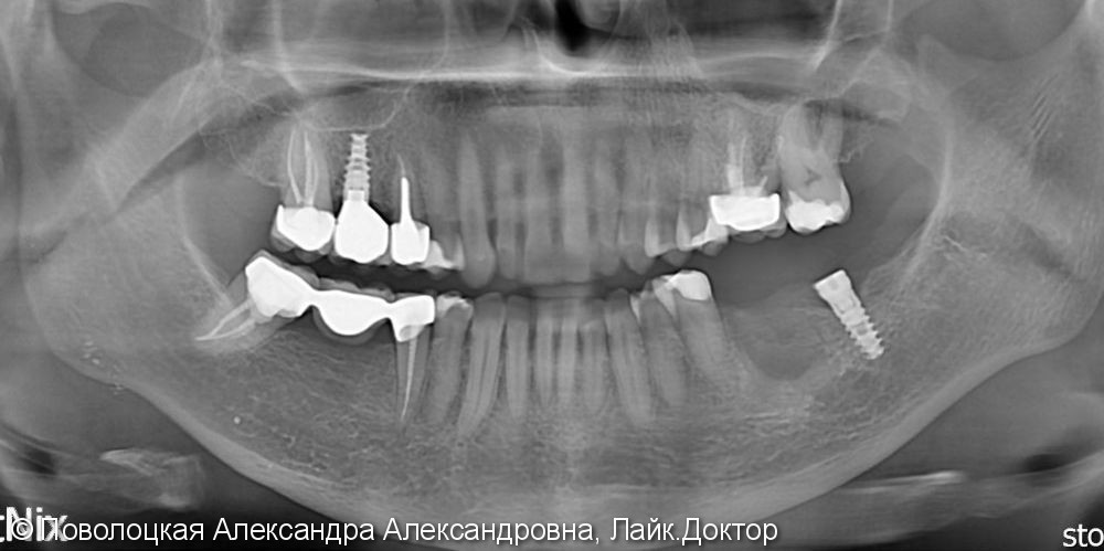 3D костная пластика и дентальная имплантация 36 зуба - фото №1