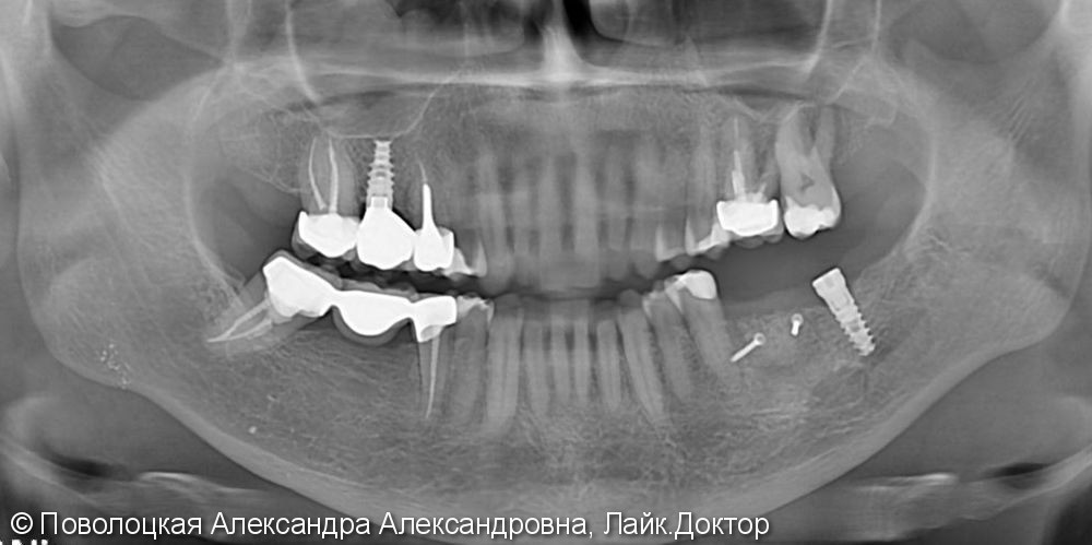 3D костная пластика и дентальная имплантация 36 зуба - фото №2