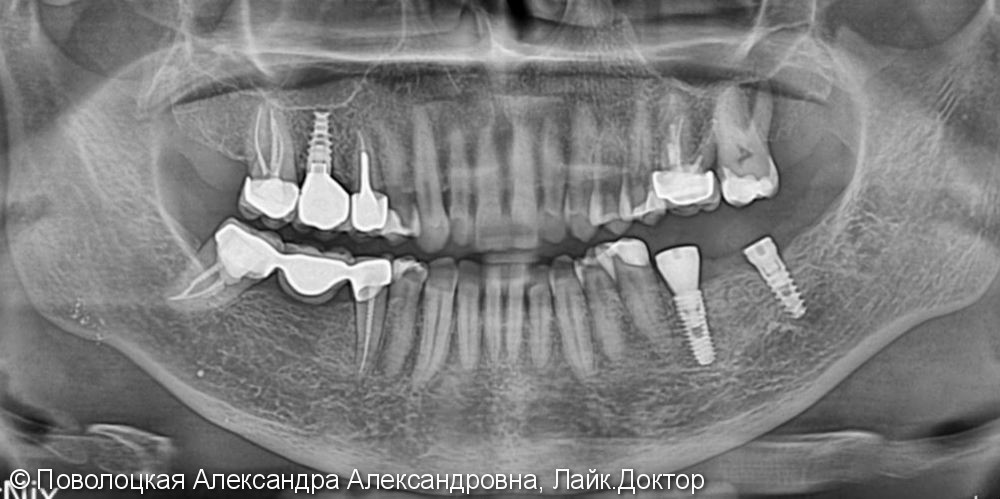 3D костная пластика и дентальная имплантация 36 зуба - фото №3